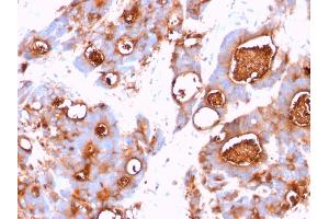 Formalin-fixed, paraffin-embedded human Colon Carcinoma stained with CEA Mouse Monoclonal Antibody (CEA31). (CEACAM5 antibody)