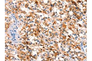 The image on the left is immunohistochemistry of paraffin-embedded Human thyroid cancer tissue using ABIN7192636(SPRN Antibody) at dilution 1/15, on the right is treated with synthetic peptide. (SPRN antibody)