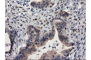 Immunohistochemical staining of paraffin-embedded Adenocarcinoma of Human colon tissue using anti-MEF2C mouse monoclonal antibody.