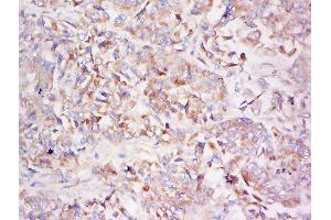 Formalin-fixed and paraffin embedded human lung carcinoma labeled with Anti-LDLRAD3 Polyclonal Antibody, Unconjugated  at 1:500 followed by conjugation to the secondary antibody and DAB staining