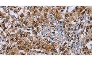 Immunohistochemistry of paraffin-embedded Human liver cancer using GTF2I Polyclonal Antibody at dilution of 1:40 (GTF2I antibody)