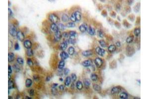 Immunohistochemistry analyzes of CrkL antibody in paraffin-embedded human lung carcinoma tissue. (CrkL antibody)