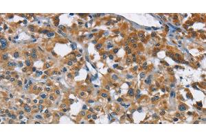 Immunohistochemistry of paraffin-embedded Human thyroid cancer tissue using ANKHD1 Polyclonal Antibody at dilution 1:40 (ANKHD1 antibody)