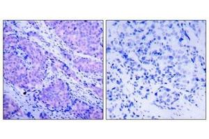 Immunohistochemical analysis of paraffin-embedded human breast carcinoma tissue using PDK1(Phospho-Ser241) Antibody(left) or the same antibody preincubated with blocking peptide(right). (PDPK1 antibody  (pSer241))