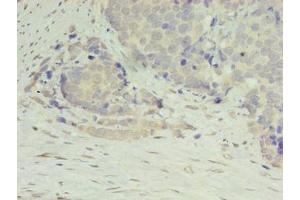 Immunohistochemistry of paraffin-embedded human gastric cancer using ABIN7150021 at dilution of 1:100 (DIP2A antibody  (AA 1-300))