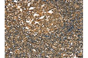 The image on the left is immunohistochemistry of paraffin-embedded Human tonsil tissue using ABIN7192667(STAB1 Antibody) at dilution 1/20, on the right is treated with synthetic peptide. (Stabilin 1 antibody)