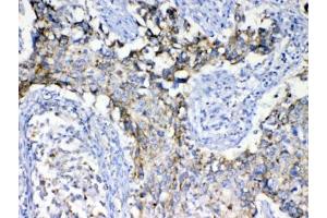 IHC testing of FFPE human lung cancer tissue with SCF antibody at 1ug/ml. (KIT Ligand antibody)