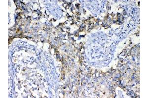IHC testing of FFPE human lung cancer tissue with SCF antibody at 1ug/ml.