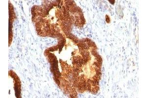 Formalin-fixed, paraffin-embedded human prostate carcinoma stained with Cytokeratin 18 antibody (KRT18/835).