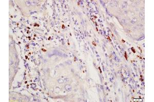 Formalin-fixed and paraffin embedded human lung cancer labeled with Rabbit Anti-SGK1 (Thr256) Polyclonal Antibody, Unconjugated 1:200 followed by conjugation to the secondary antibody and DAB staining