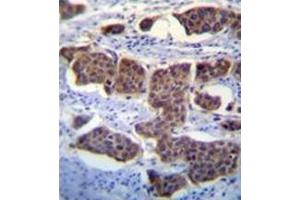 Iimmunohistochemistry analysis in formalin fixed and paraffin embedded human bladder carcinoma reacted with PALM3 Antibody (C-term) followed by peroxidase conjugation of the secondary antibody and DAB staining. (PALM3 antibody  (C-Term))