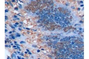 Detection of Ki-67 in Human Colorectal cancer Tissue using Polyclonal Antibody to Ki-67 Protein (Ki-67) (Ki-67 antibody  (AA 2815-2928))