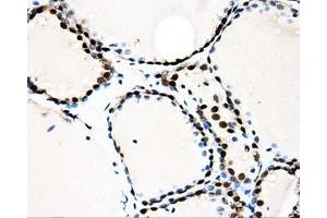 Immunohistochemical staining of paraffin-embedded Adenocarcinoma of ovary tissue using anti-LOXmouse monoclonal antibody. (LOX antibody  (AA 22-168))