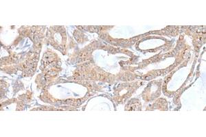 Immunohistochemistry of paraffin-embedded Human thyroid cancer tissue using PLGLB2 Polyclonal Antibody at dilution of 1:65(x200) (PLGLB2 antibody)