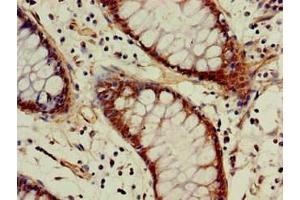 Immunohistochemistry of paraffin-embedded human colon cancer using ABIN7142946 at dilution of 1:100 (ACAT1 antibody  (AA 76-106))
