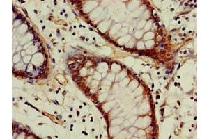 Immunohistochemistry of paraffin-embedded human colon cancer using ABIN7142946 at dilution of 1:100 (ACAT1 antibody  (AA 76-106))