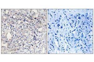 Immunohistochemistry analysis of paraffin-embedded human liver carcinoma tissue, using Heparin Cofactor II antibody. (SERPIND1 antibody  (N-Term))