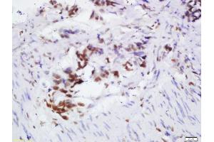 Formalin-fixed and paraffin embedded human colon cancer labeled with Rabbit Anti-OGG1 Polyclonal Antibody, Unconjugated 1:200 followed by conjugation to the secondary antibody and DAB staining, (OGG1 antibody  (AA 151-250))