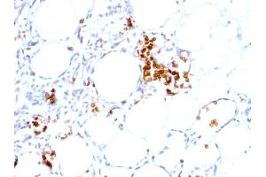 Formalin-fixed, paraffin-embedded human Angiosarcoma stained with Glycophorin A Mouse Monoclonal Antibody (GYPA/280). (CD235a/GYPA antibody)