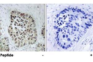 Immunohistochemical analysis of paraffin-embedded human lung carcinoma tissue using DCLRE1C polyclonal antibody .