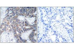 Immunohistochemical analysis of paraffin-embedded human breast carcinoma tissue using MEK1/MEK2(Phospho-Ser217/Ser221) Antibody(left) or the same antibody preincubated with blocking peptide(right). (MEK1 antibody  (pSer217, pSer221))