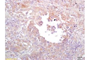 Formalin-fixed and paraffin embedded human lung carcinoma labeled with Rabbit Anti ERK1/2(p44/42 MAPK) Polyclonal Antibody, Unconjugated (ABIN748373) at 1:200 followed by conjugation to the secondary antibody and DAB staining