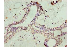 Immunohistochemistry of paraffin-embedded human breast cancer using ABIN7168634 at dilution of 1:100 (Sclerostin antibody  (AA 24-213))