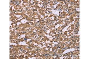 Immunohistochemistry of Human thyroid cancer using IFNA2 Polyclonal Antibody at dilution of 1:40