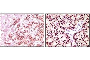 Immunohistochemical analysis of paraffin-embedded human breast carcinoma, using ER-alpha mouse mAb showing nuclear expression with DAB staining. (Estrogen Receptor alpha antibody)