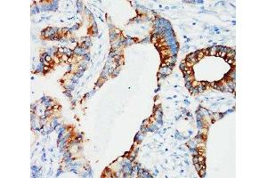 IHC-P: IGFBP3 antibody testing of human breast cancer tissue (IGFBP3 antibody  (Middle Region))