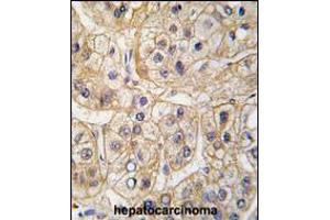 Formalin-fixed and paraffin-embedded human hepatocarcinoma tissue reacted with EGFR Antibody (S1070), which was peroxidase-conjugated to the secondary antibody, followed by DAB staining.