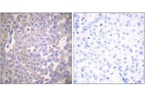 Immunohistochemistry analysis of paraffin-embedded human breast carcinoma tissue, using Claudin 2 Antibody.