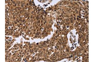 The image on the left is immunohistochemistry of paraffin-embedded Human cervical cancer tissue using ABIN7129394(ERCC6L Antibody) at dilution 1/30, on the right is treated with fusion protein.