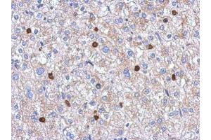 IHC-P Image Immunohistochemical analysis of paraffin-embedded human hepatoma, using MYST2, antibody at 1:250 dilution. (MYST2 antibody  (Internal Region))