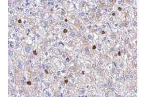 IHC-P Image Immunohistochemical analysis of paraffin-embedded human hepatoma, using MYST2, antibody at 1:250 dilution. (MYST2 antibody  (Internal Region))