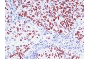 Formalin-fixed, paraffin-embedded human lung carcinoma stained with TTF1 antibody (8G7G3/1 + NX2.