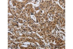 Immunohistochemistry of Human ovarian cancer using PDCD7 Polyclonal Antibody at dilution of 1:60