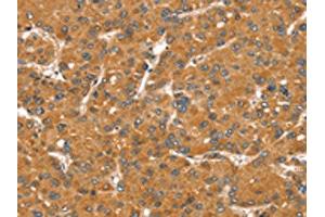 The image on the left is immunohistochemistry of paraffin-embedded Human liver cancer tissue using ABIN7131123(SNX11 Antibody) at dilution 1/30, on the right is treated with fusion protein. (SNX11 antibody)