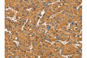 The image on the left is immunohistochemistry of paraffin-embedded Human liver cancer tissue using ABIN7131123(SNX11 Antibody) at dilution 1/30, on the right is treated with fusion protein.