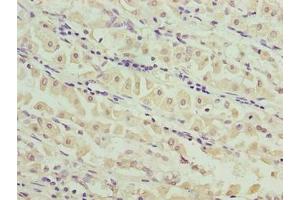 Immunohistochemistry of paraffin-embedded human gastric cancer using ABIN7159191 at dilution of 1:100 (MND1 antibody  (AA 2-205))