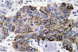 Immunohistochemistry analysis of RANTES Antibody in paraffin-embedded human lung carcinoma tissue. (CCL5 antibody)