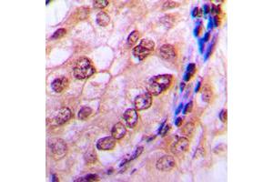 Immunohistochemical analysis of CDC6 (pS54) staining in human breast cancer formalin fixed paraffin embedded tissue section. (CDC6 antibody  (N-Term, pSer54))
