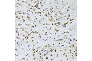Immunohistochemistry of paraffin-embedded human gastric cancer using RAD50 Antibody. (RAD50 antibody)