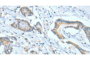 Immunohistochemistry of paraffin-embedded Human colon cancer tissue using ASCC1 Polyclonal Antibody at dilution 1:50 (ASCC1 antibody)