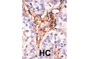 Formalin-fixed and paraffin-embedded human cancer tissue reacted with the primary antibody, which was peroxidase-conjugated to the secondary antibody, followed by AEC staining. (APOBEC3G antibody  (AA 118-148))