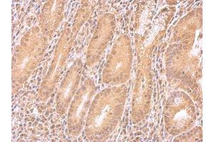 IHC-P Image IMPDH2 antibody detects IMPDH2 protein at cytosol on human colon carcinoma by immunohistochemical analysis. (IMPDH2 antibody)