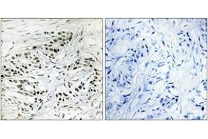 Immunohistochemistry analysis of paraffin-embedded human breast carcinoma tissue, using ERF Antibody. (ERF antibody  (AA 471-520))