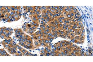 Immunohistochemistry of paraffin-embedded Human liver cancer using IGF2BP1 Polyclonal Antibody at dilution of 1:40 (IGF2BP1 antibody)