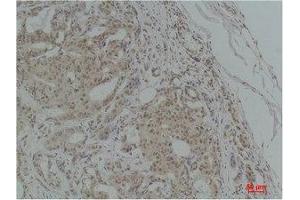 Immunohistochemistry (IHC) analysis of paraffin-embedded Human Breast Carcinoma using TGFbeta1 Polyclonal Antibody.