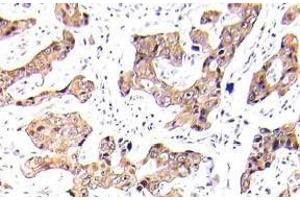 Immunohistochemistry (IHC) analyzes of p-FKHR/FOXO1A antibody in paraffin-embedded human breast carcinoma tissue. (FOXO1 antibody  (pSer256))
